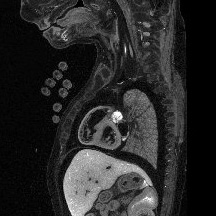 Fetal Scans